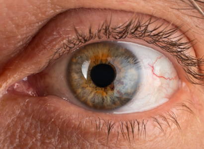 Corneal Transplant